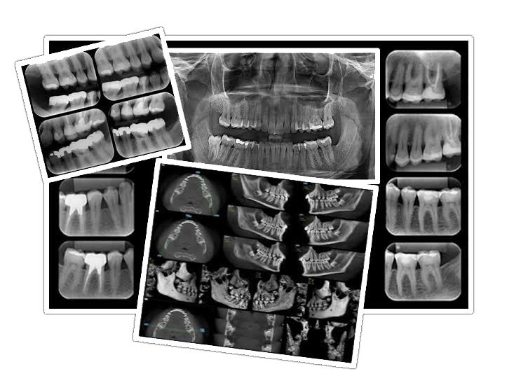 Montagem com arcadas dentárias